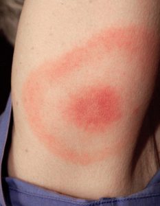 Lyme Disease rash